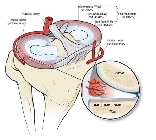 Meniscus Tear